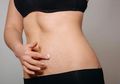 8 Fakta Yang Perlu Kita Tahu Tentang Stretch Marks