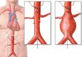 Metode EVAR Jadi Alternatif Atasi Pembengkakan Aorta