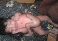 Di India, Ada Bayi Lahir dengan Empat Kaki dan Dua Penis
