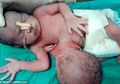 Suami Istri Ini Tetap Merasa Sedih Meski Dokter Berhasil Lepaskan ‘Parasit’ dari Tubuh Bayinya