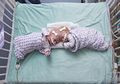 Luar Biasa! Akhirnya Bayi Kembar Siam di Kepala Ini Bisa Dipisahkan dan Hidup Normal