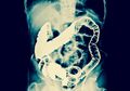 Wow, Dokter Keluarkan Kotoran Padat Seberat 12 Kg dari Tubuh Seorang Pria, Ini Penjelasan Ilmiahnya