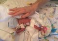 Lahir Prematur 23 Minggu, Bayi Mungil dengan Berat Hanya 0,5 Kg Ini Berhasil Selamat!