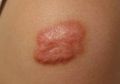 Keloid Jinak tapi Mengganggu, Bila Memang Tidak Mengganggu Ya Sudah Berdamai Saja!