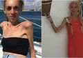 Diet Berlebihan, Wanita Ini Nyaris Mati dengan Tubuh Sangat Kurus, Tapi Lihat Kondisinya Kini!