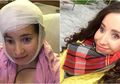 Dilahirkan dengan Separuh Tulang Wajah yang Rusak, Wanita Ini Jalani Operasi 13 Jam Agar Wajahnya Normal