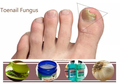 Jangan Panik Bila Kuku Kaki Berjamur, Obati Segera dengan 6 Bahan Alami Ini dan Rasakan Hasilnya