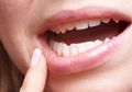 Hati-hati, 5 Penyakit Ini Bisa Menular Karena Ciuman, Berikut Gejala-gejalanya!