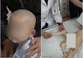 Lahir dengan Tiga Kaki, Bayi 11 Bulan Ini Menjalani Prosedur Operasi yang Rumit Hampir 10 Jam