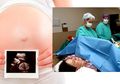 Diagnostik Prenatal NonInvasif