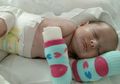 Wah! Bayi ‘Kaus Kaki’ Ini Memiliki Kondisi Kulit Langka
