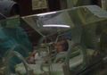 Seorang Bayi Perempuan Lahir dengan Dua Kepala