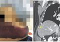 Ngeri! Akibat Batuk Terlalu Keras, Tulang Rusuk Perempuan Ini Patah