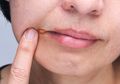 Perih Karena Radang di Sudut Bibir? Obati dengan 4 Resep Manjur Ini
