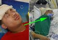 Sempat Hanya Rasakan Sakit Kepala dan Demam Biasa, Namun 2 Minggu Kemudian Pria Ini Meninggal, Kok Bisa?