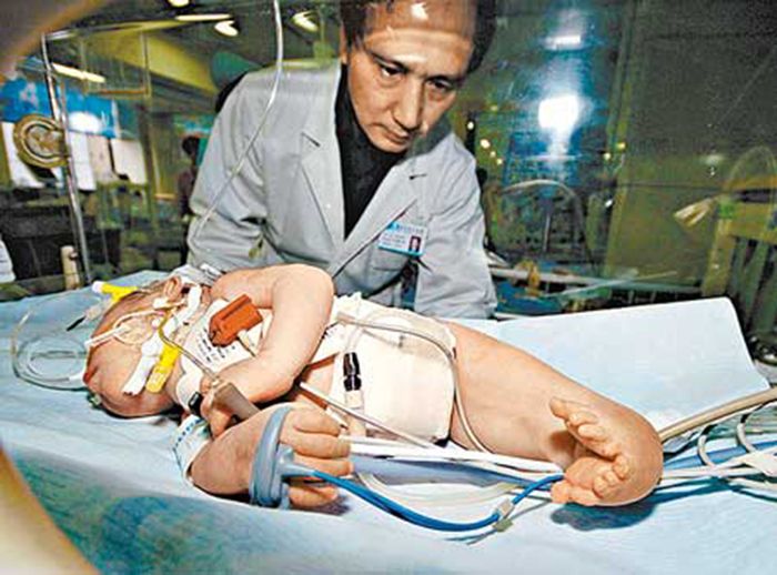 Bayi sindrome putri duyung dari Cina