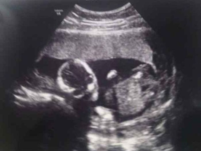 hasil USG yang memperlihatkan bayi yang sedang menatap dengan sangat tajam