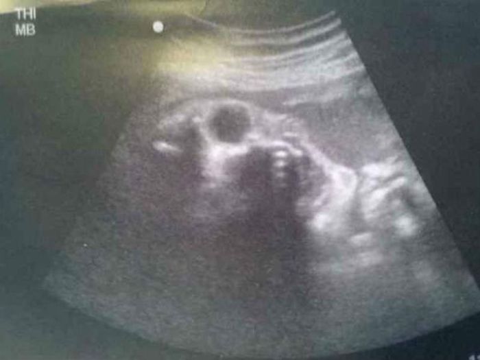 hasil USG yang menunjukan 'the skleton baby'