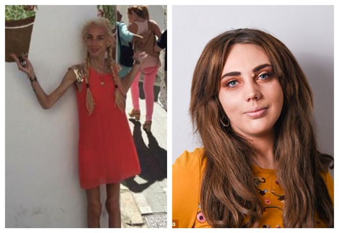 Diet ekstrim hingga jadi kurus, perempuan ini kembali cantik