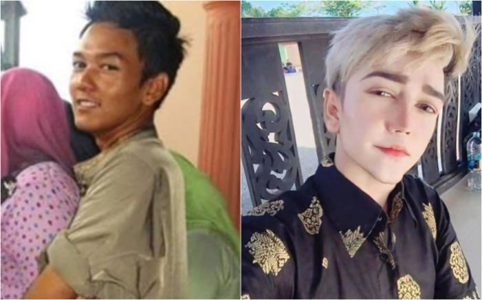 Amirul setelah melakukan operasi