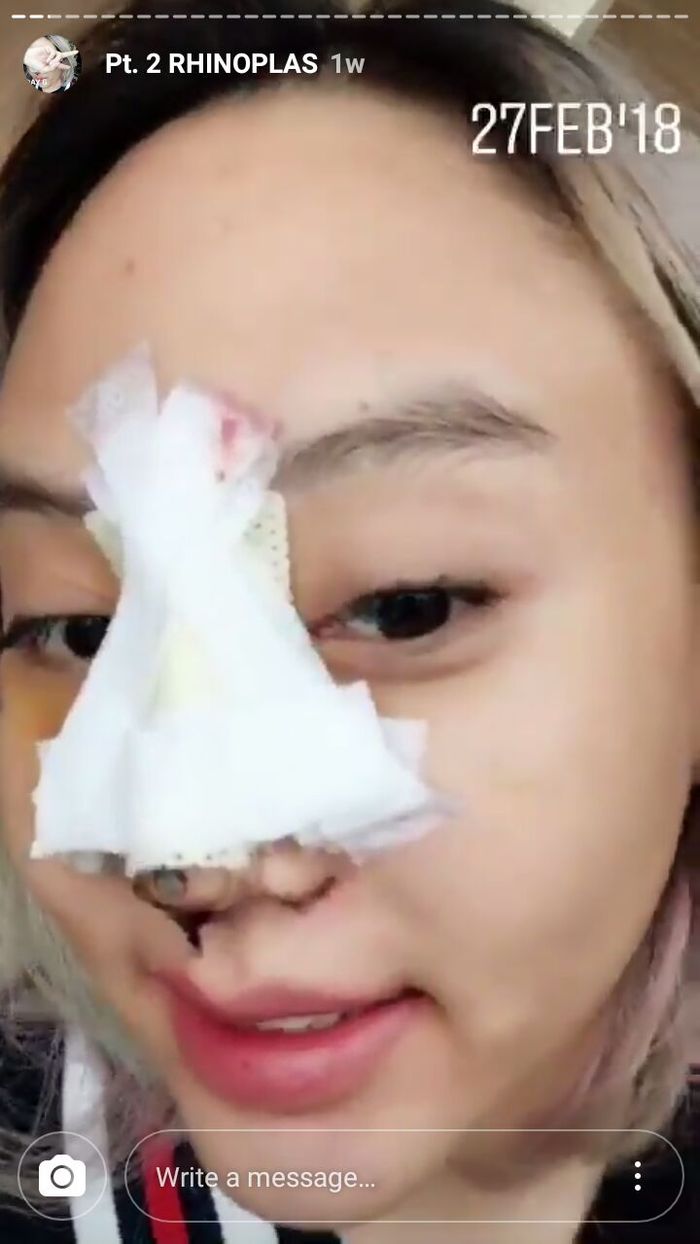 Janine Intansari Sebelum Lepas Perban