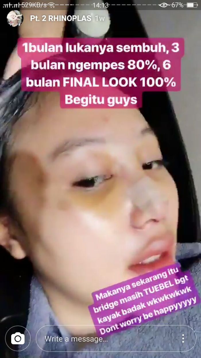 Tahapan Operasi Plastik Menurut Janine Intansari