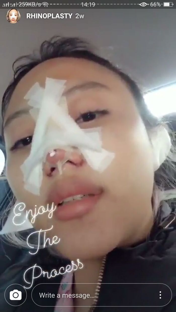 Wajah dan Hidung Janine Intansari Pascaoperasi