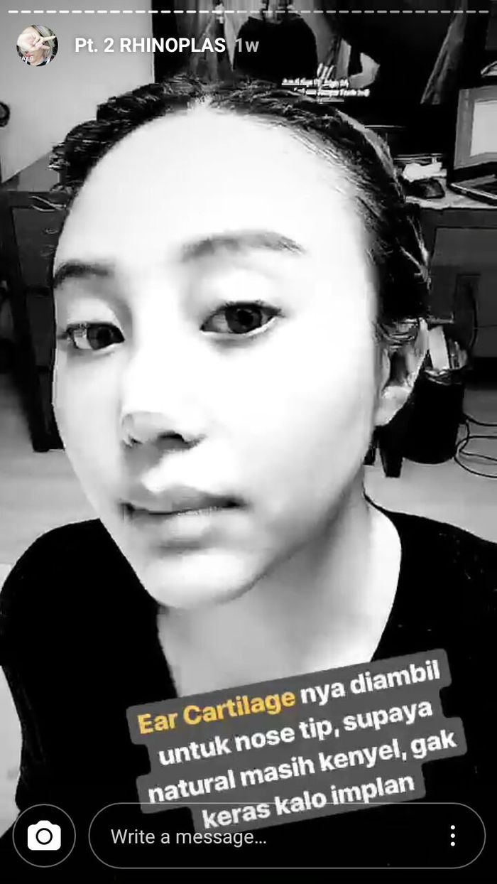 Untuk Membuat Bentuk Hidung yang Natural, Membutuhkan Pengambilan Tulang Telinga