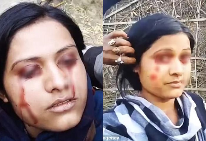 Geeta alami penyakit hematohidrosis