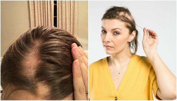 Kondisi rambut Michelle yang mulai rontok