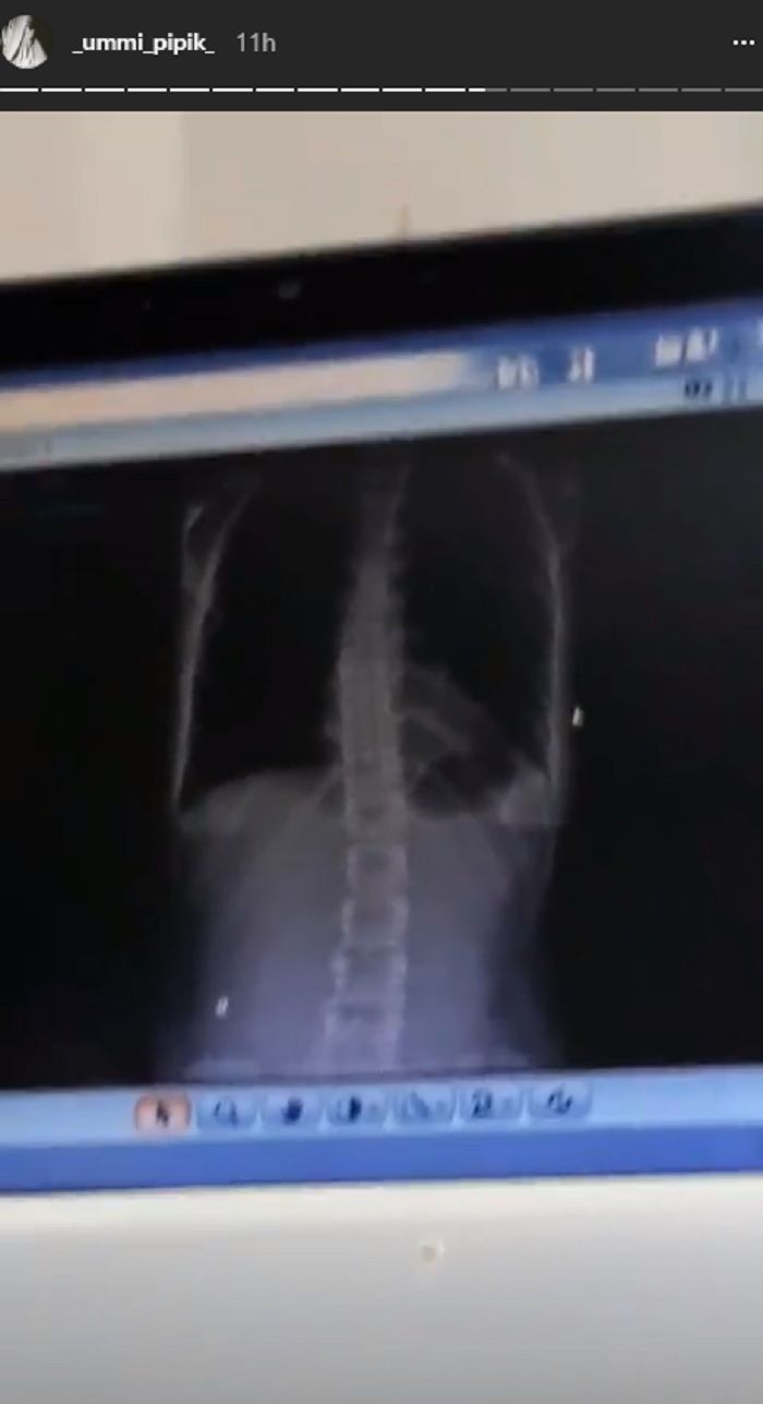 Hasil CT Scan Ummi Pipik instagram.com/_ummi_pipik_