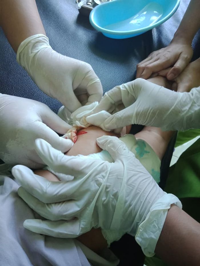 Benjolan di bekas luka suntikan imunisasi