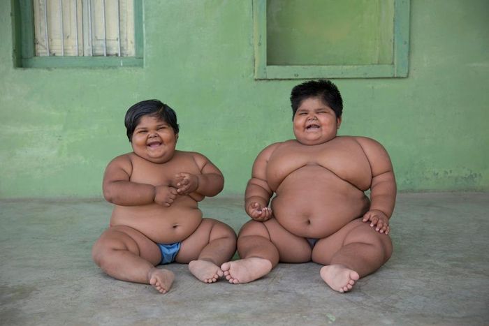 Kakak beradik asal India menderita obesitas di usia muda