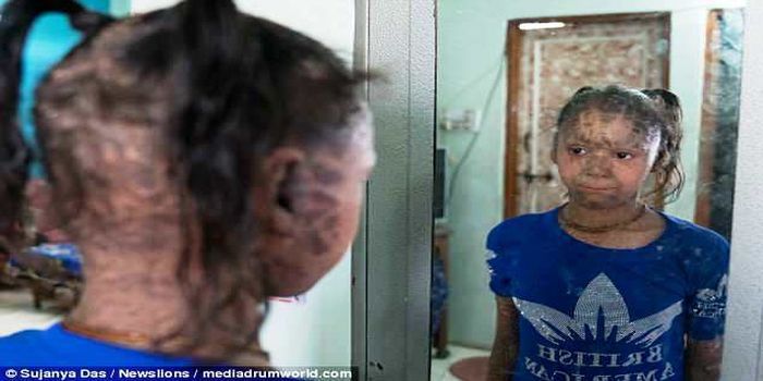 Vedika berharap kondisinya bisa diperbaiki setidaknya 50 persen agar bisa percaya diri
