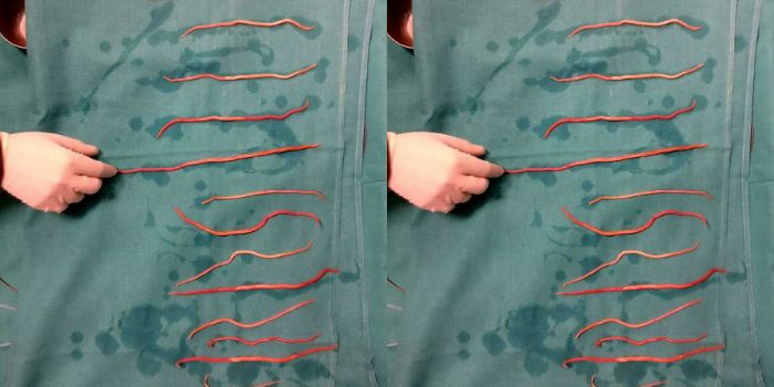 Cacing gelang dari tubuh Sunita