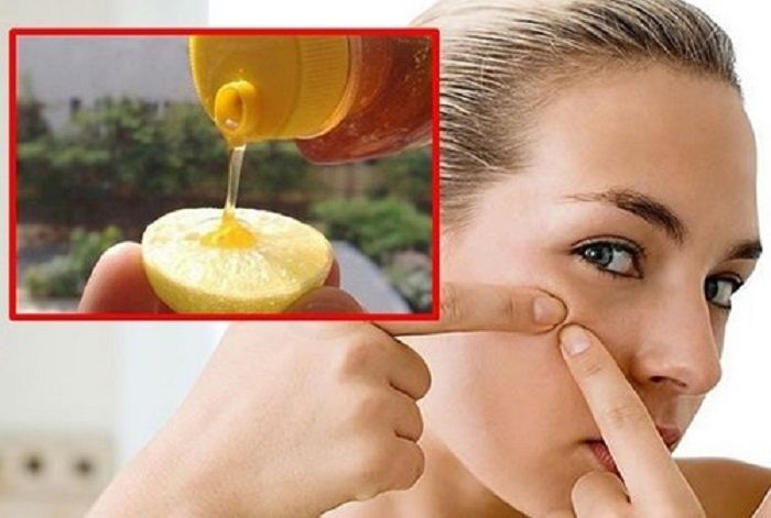 Bahan alami ini ampuh menghilangkan komedo dalam 5 menit
