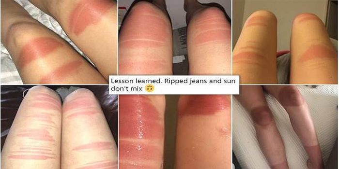 Paha jadi belang setelah memakai celana jeans sobek yang terkena sinar matahari.