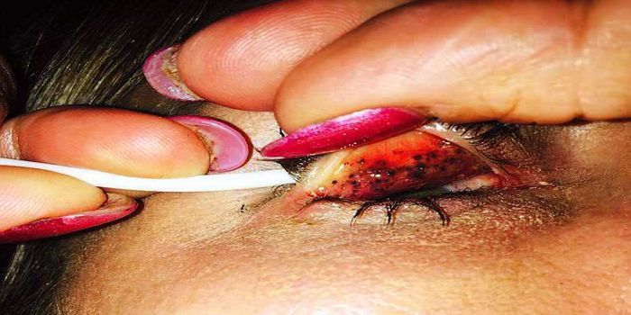 Setiap kali mengedip bintik akan menggores kornea mata.
