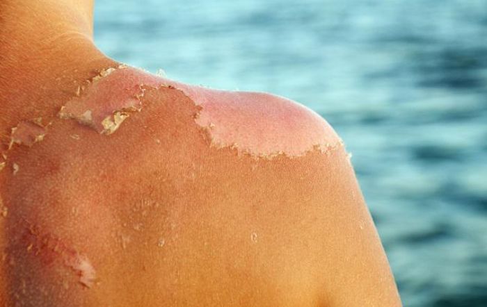 Kulit yang mengelupas