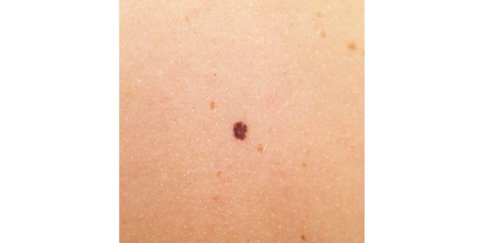 Dysplastik Nevus