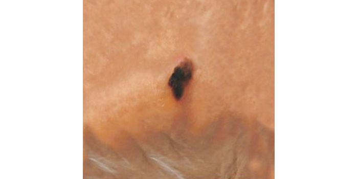 Acral Lentiginous Melanoma