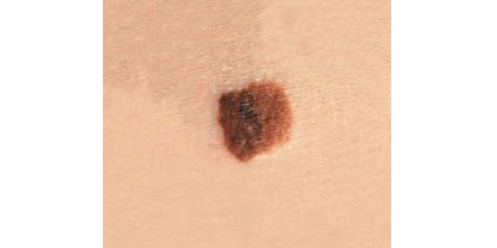 Melanoma