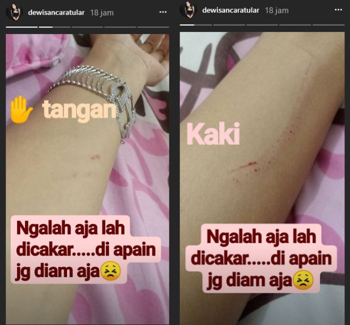 Dewi Sanca perlihatkan tangan dan kakinya yang kena cakar
