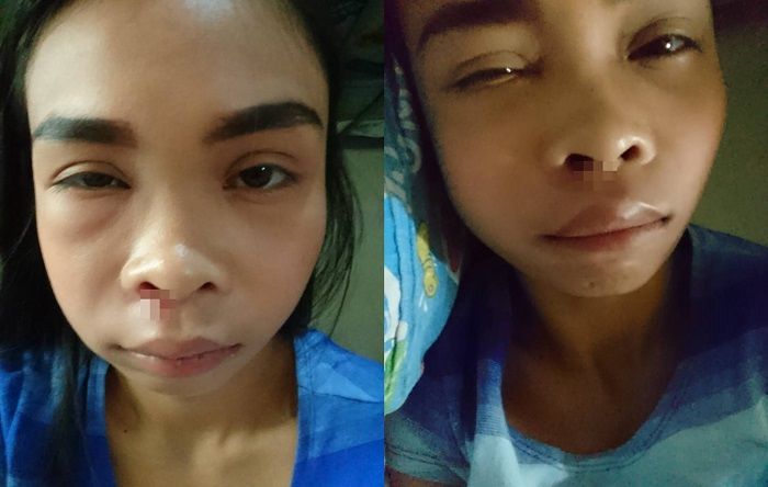 Mata dan bibir Hannah mengalami pembengkakan Facebook/ Hannah Christine Santos Torres