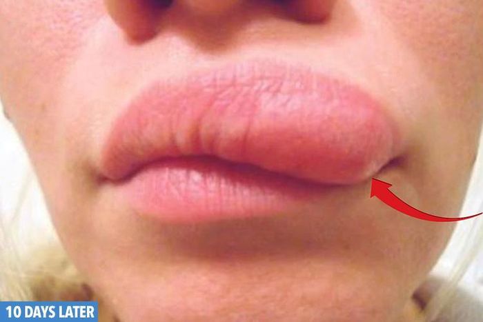 Cacing sampai ke bibir
