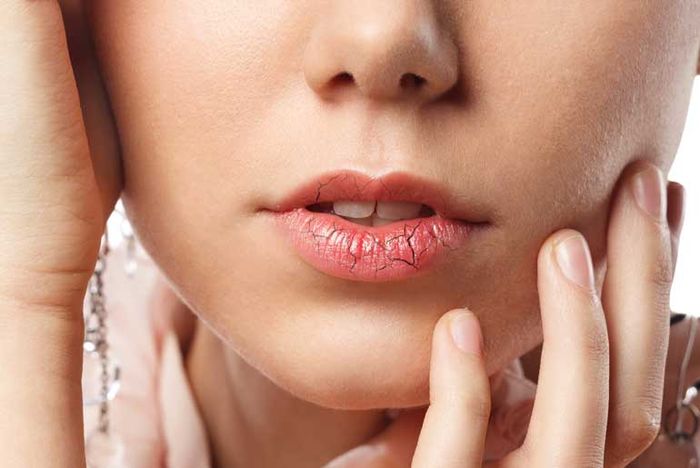 Mengatasi bibir pecah-pecah