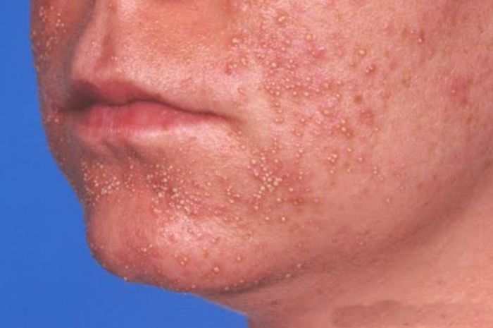 Folliculitis