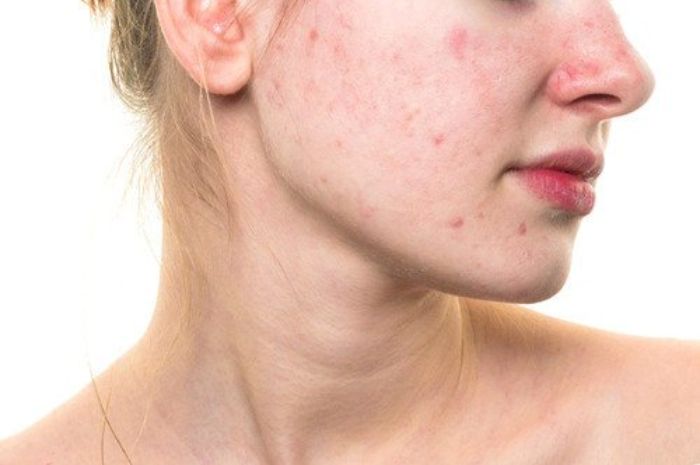 Rosacea