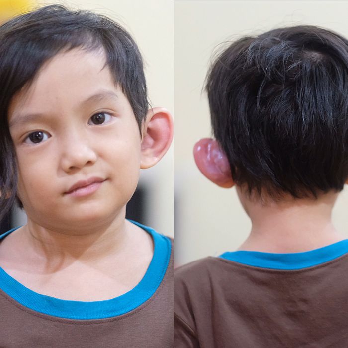 Sinur Preauricular yang diidap Saga