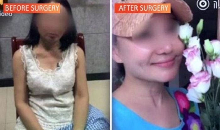 asiaone
Sebelum dan sesudah operasi plastik.